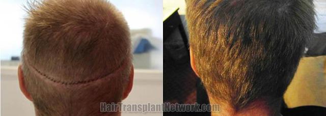 Hair restoration procedure before and after pictures