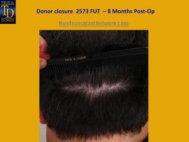 Hair restoration surgery before and after photos