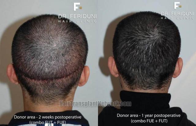 Hair transplant surgery before and after images