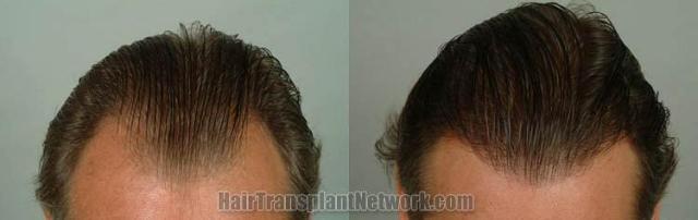 Before and after hair transplantation result photographs