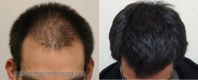 Top view before and after hair restoration results