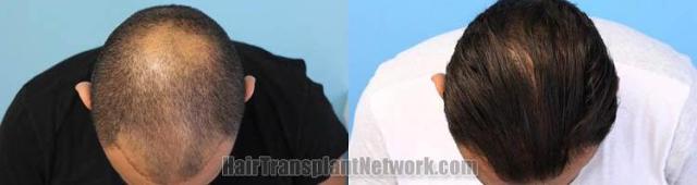 Hair transplantation surgery before and after photos