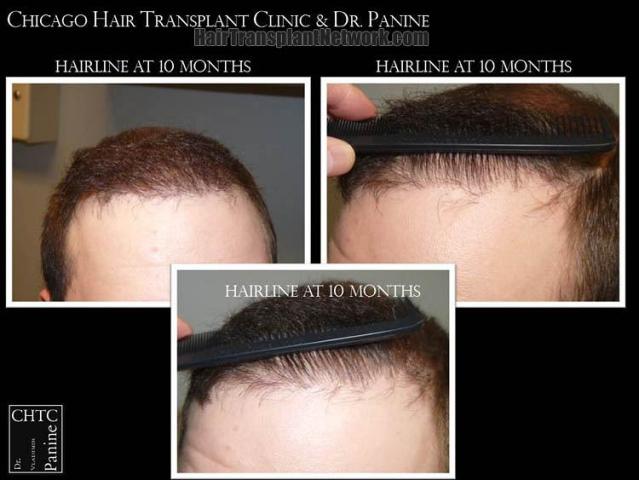 air transplant surgery hairline closeups