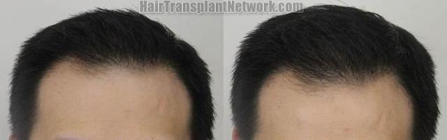 Hair restoration procedure before and after results