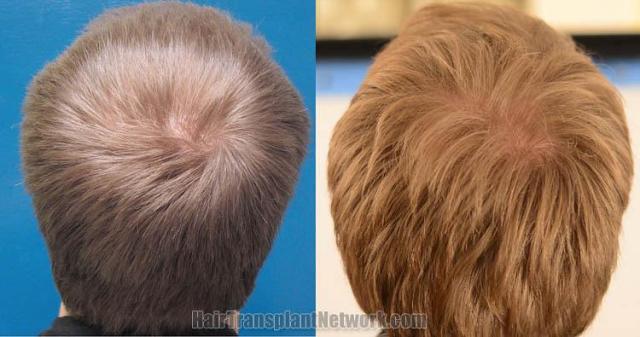 Hair restoration procedure before and after pictures