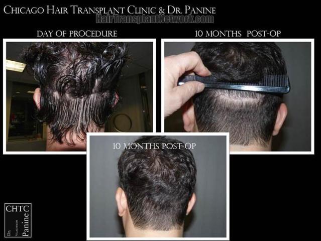 Hair restoration procedure before and after pictures