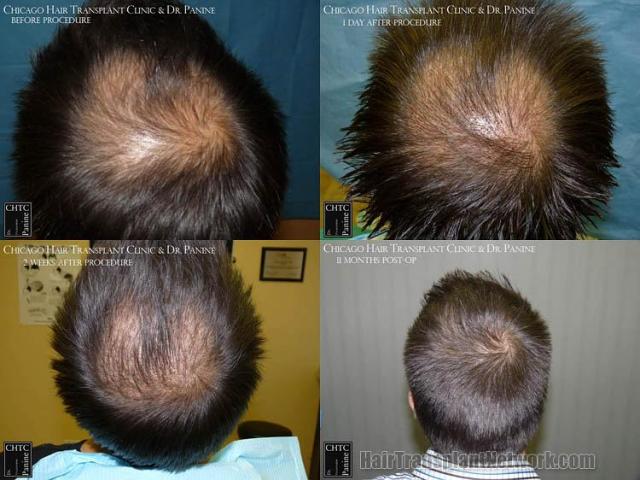 Hair transplantation surgery before and after images