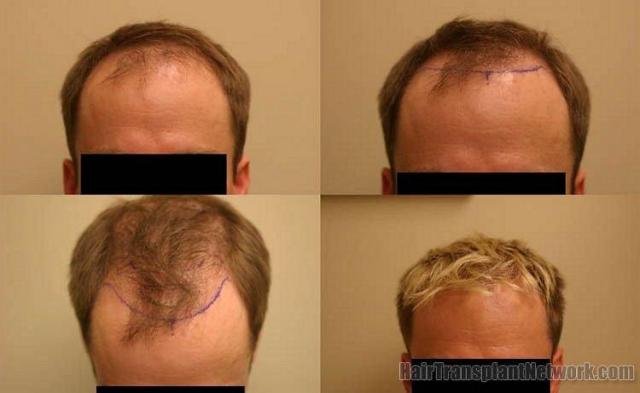 Hair replacement surgery patient before and after results