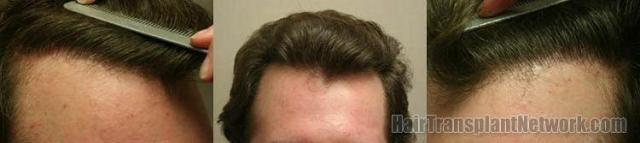 Hairline closeups of  patient