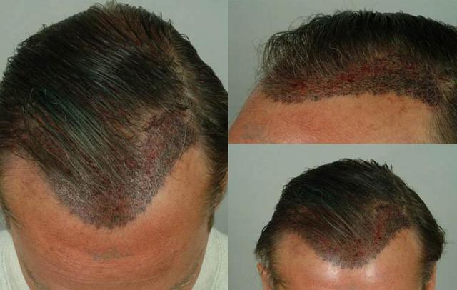 Surgical hair transplantation result photographs