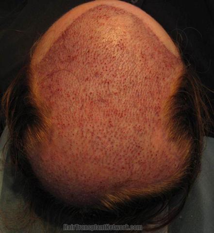 Hair restoration surgery before and after images