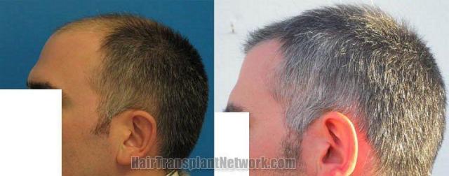 Hair restoration procedure results