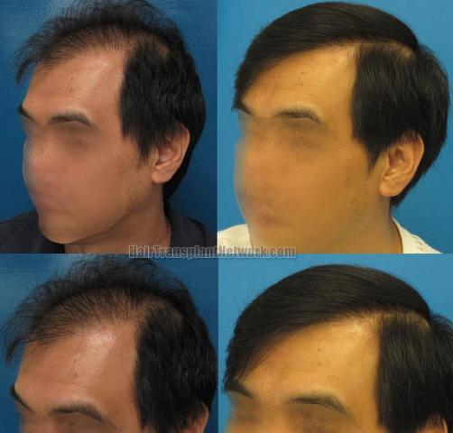 Hair transplantation surgery before and after photos