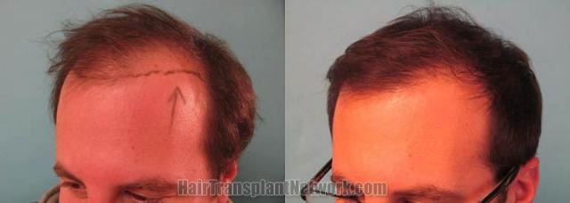 Hair transplantation surgery before and after photos