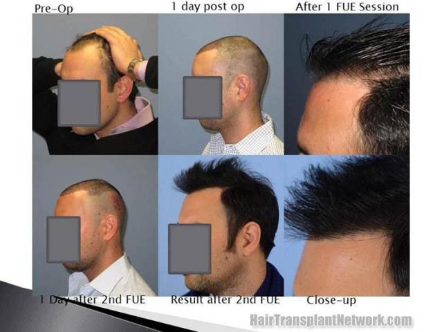 Hair transplantation surgery before and after pictures