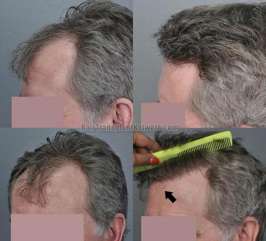 Hair restoration procedure before and after pictures