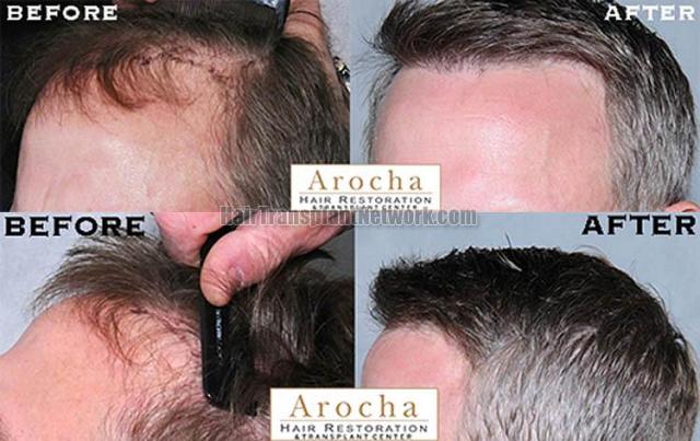 Hair transplantation surgery before and after images