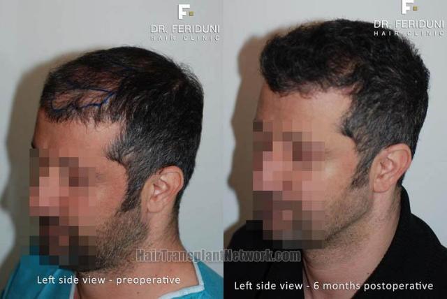 Hair transplantation surgery before and after pictures