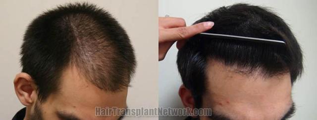 Before and after surgical hair restoration images