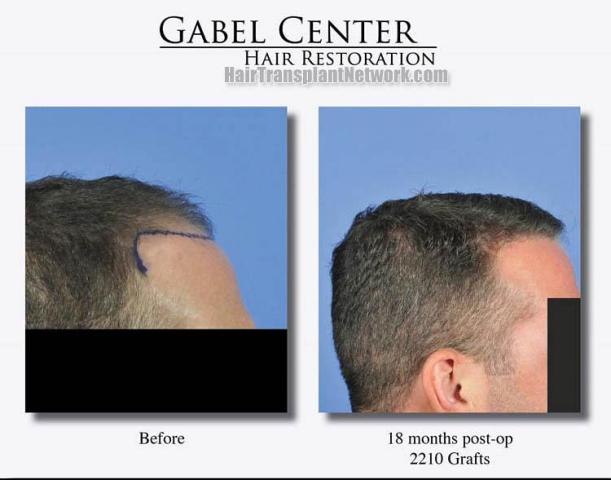 Hair transplantation surgery before and after photos