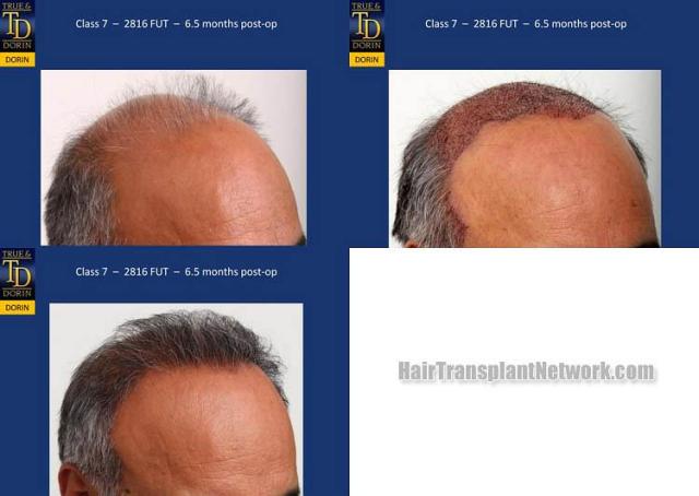 Hair transplantation surgery before and after photos