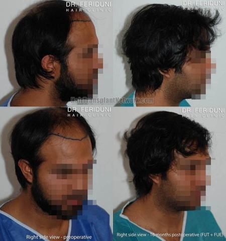 Hair transplantation surgery before and after photos