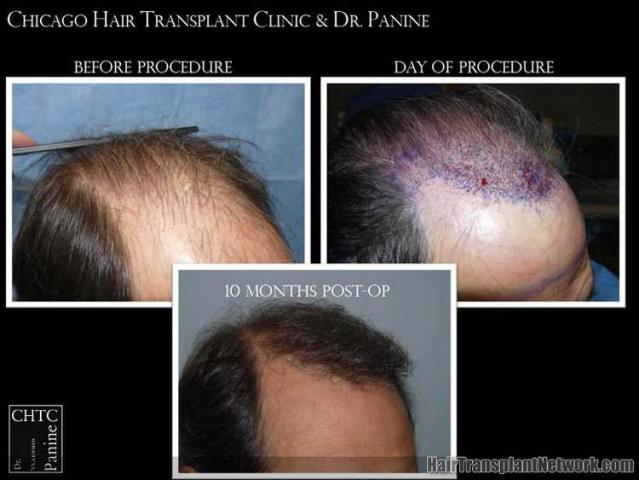 Hair transplantation surgery before and after images