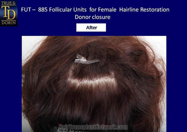 Hair restoration procedure before and after pictures