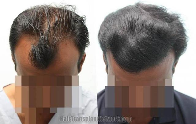 Hair transplantation surgery before and after photos