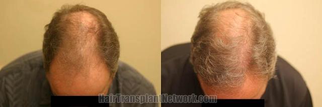 Hair transplantation surgery before and after photos