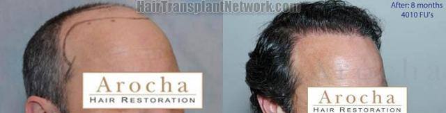 Hair transplantation surgery before and after images