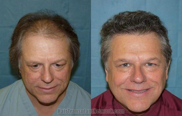 Hair transplant photo results before and after surgery