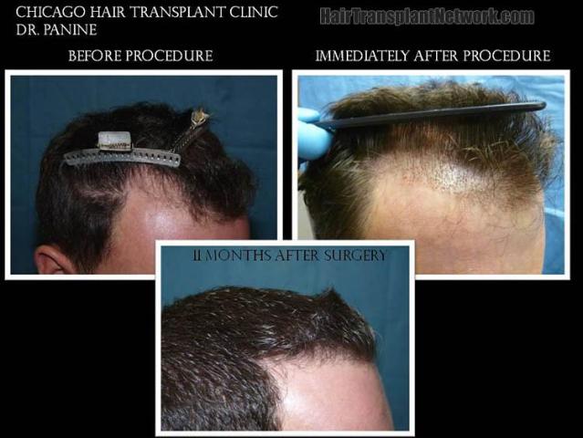 Hair restoration procedure before and after results