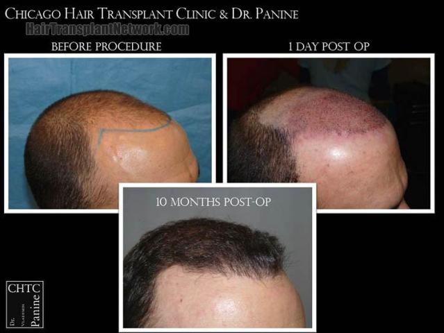 Hair transplantation surgery before and after photos