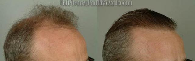 Hair transplantation surgery before and after images