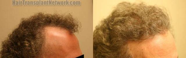 Hair restoration procedure before and after results