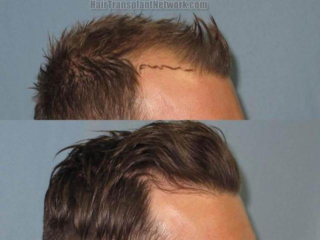 Hair restoration procedure before and after pictures