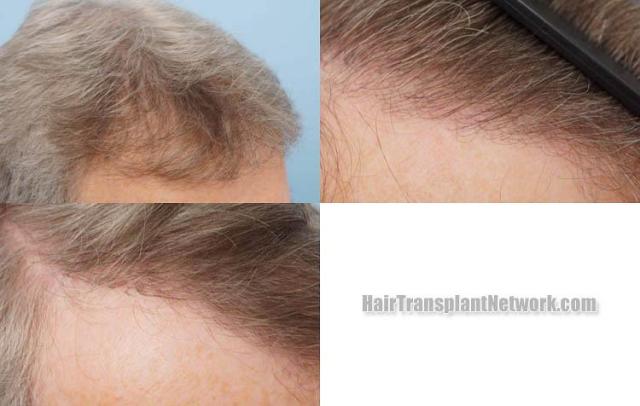 Hair transplantation surgery before and after photos