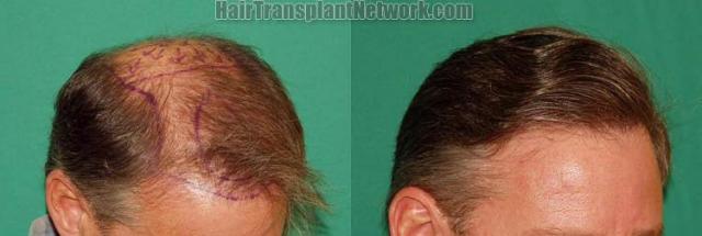 Hair transplantation surgery before and after images