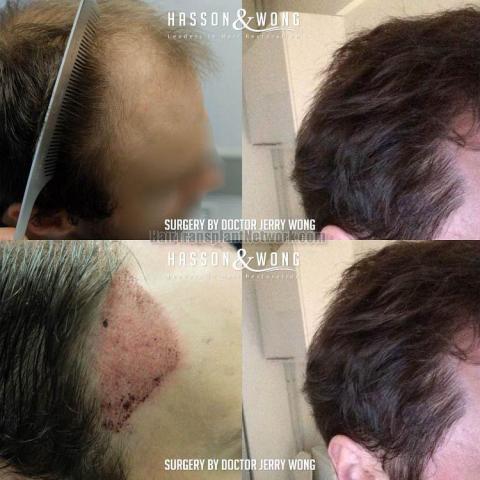 Hair transplantation procedure before and after results