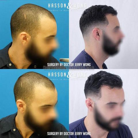 Hair transplantation procedure before and after results