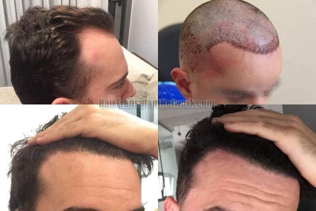 Hair restoration procedure before and after result images