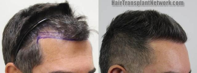 Hair restoration procedure after result images