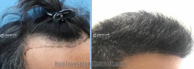 Hair transplantation procedure before and after results