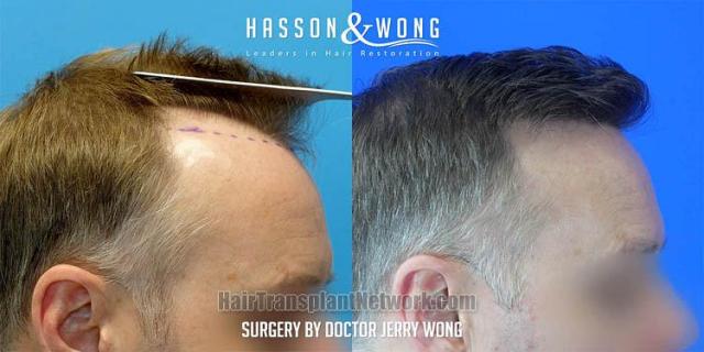 Hair restoration procedure after result images