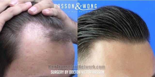 Hair transplantation procedure before and after results