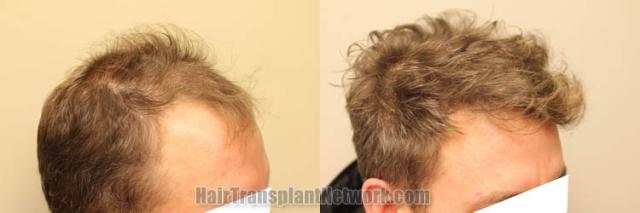 Hair transplantation procedure before and after results