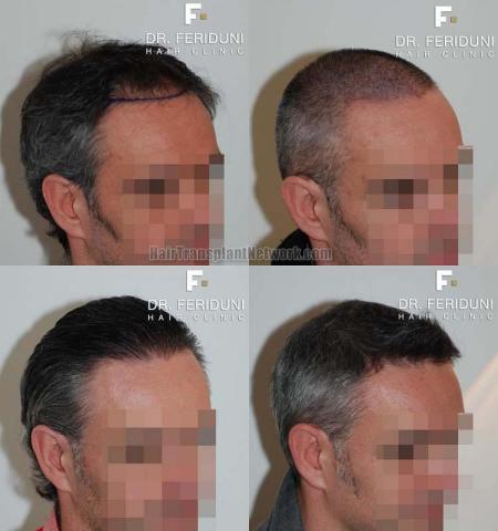 Hair restoration procedure before and after pictures