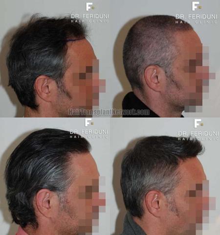 Hair restoration procedure before and after results