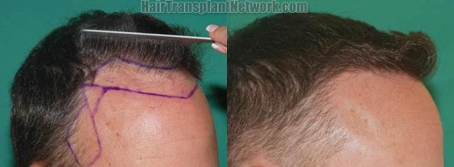 Hair restoration procedure before and after results